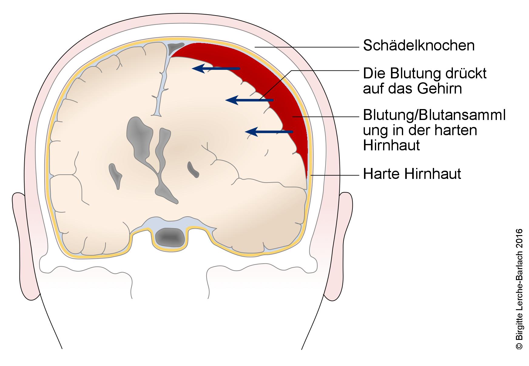 Hämatom Schwangerschaft Wie Lange Blutung deximed.de